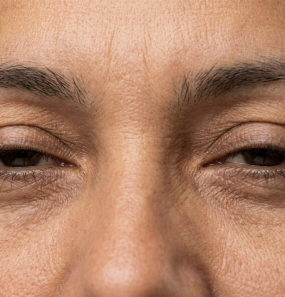 Close-up dos olhos semicerrados por contração involuntária, ilustrando blefaroespasmo