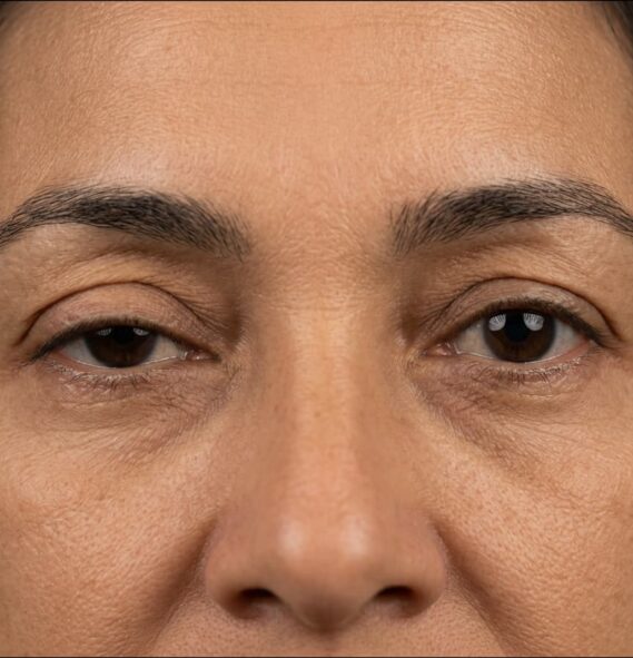 Ptose Palpebral