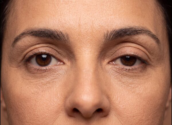 Ptose Palpebral: Quando a Pálpebra Caída Precisa de Tratamento