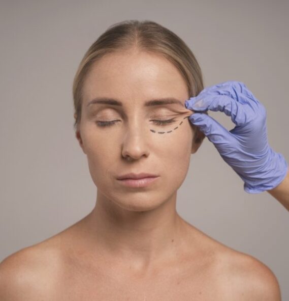 Blefaroplastia