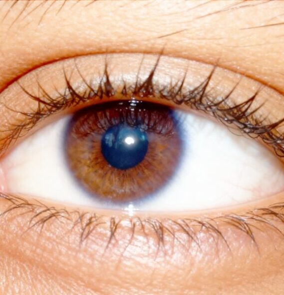 Triquíase Triquíase