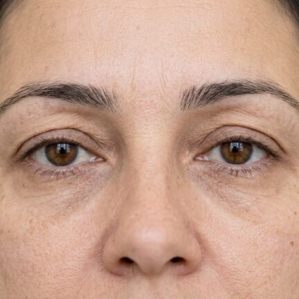 Blefaroespasmo e Espasmo Hemifacial