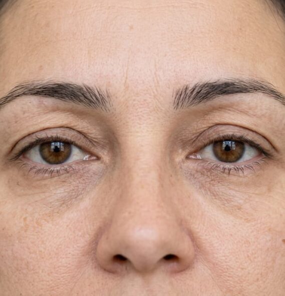 Blefaroespasmo e Espasmo Hemifacial