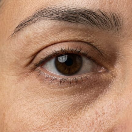 Close-up do olho parcialmente aberto, ilustrando dificuldade de fechamento por paralisia facial