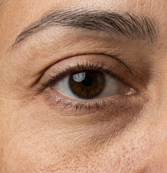 Close-up do olho parcialmente aberto, ilustrando dificuldade de fechamento por paralisia facial